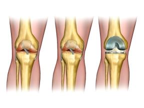 Inflamed joints